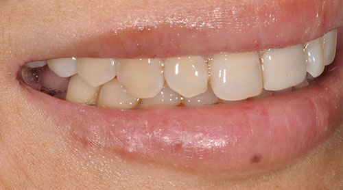 Dental Implants Before