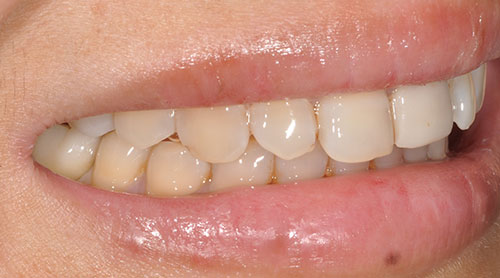 Dental Implants After